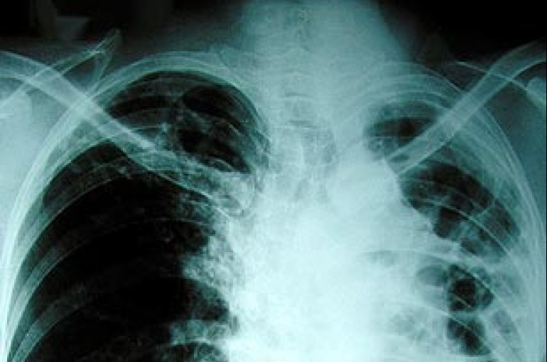 Այս հայտնագործությունը օգուտ կբերի թոքերի ոչ մանր բջջային քաղցկեղով բոլոր հիվանդներին