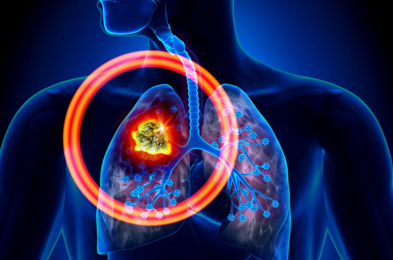 Թոքերի քաղցկեղ, որոնք ուղեկցվում են հետևյալ ախտանշաններով